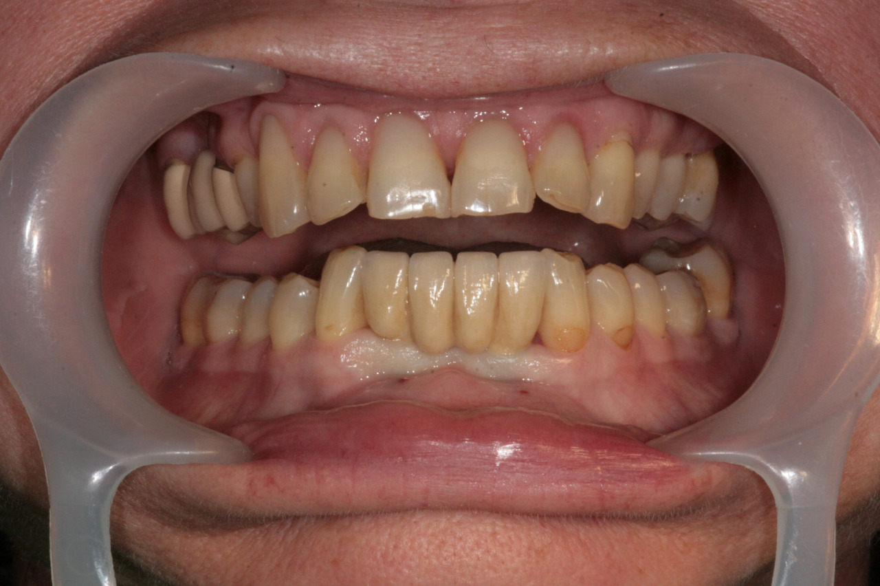 Zubní implantáty Brno - Dentamedika.cz - 12_2