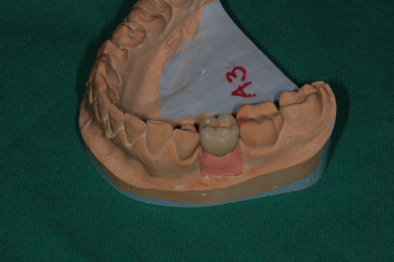 Zubní implantáty Brno - Dentamedika.cz - 13_11