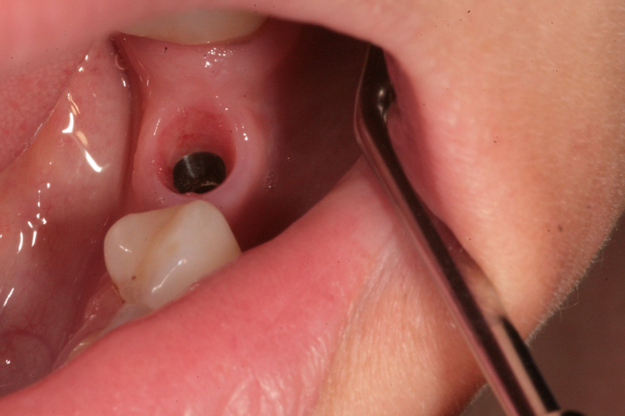 Zubní implantáty Brno - Dentamedika.cz - 13_2