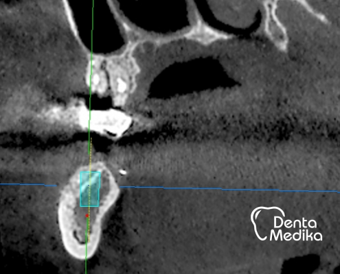Doplnění kosti čelisti před implantací Brno 007