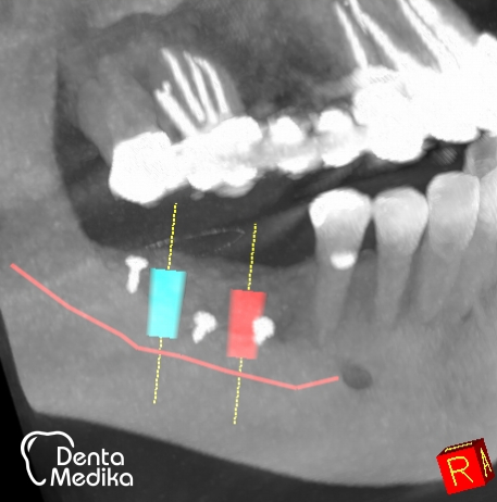 Doplnění kosti čelisti před implantací Brno 008