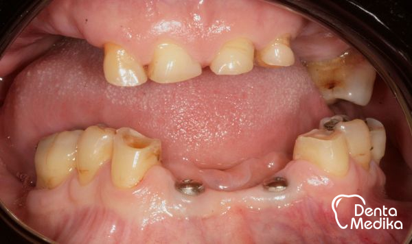 Implantáty zubů Brno - Dentamedika_cz - 17_2
