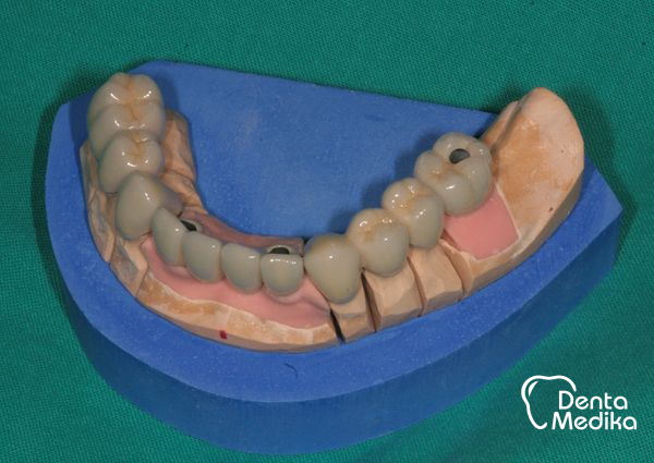 Implantáty zubů Brno - Dentamedika_cz - 17_3