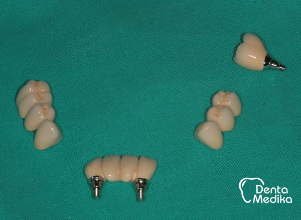 Implantáty zubů Brno - Dentamedika_cz - 17_4