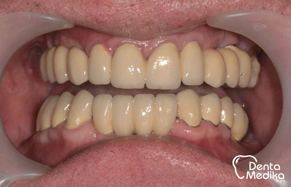 Implantáty zubů Brno - Dentamedika_cz - 17_5