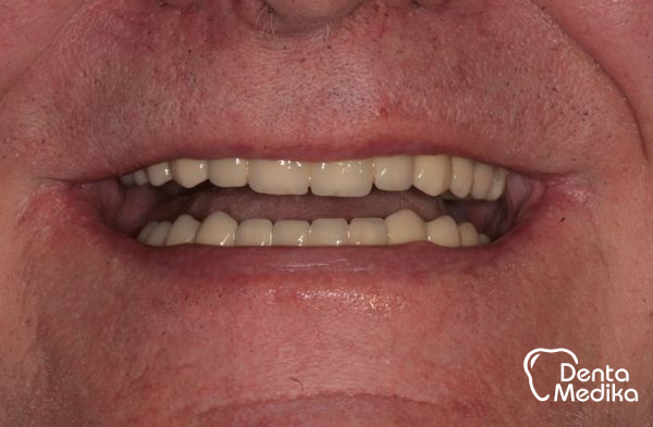 Implantáty zubů Brno - Dentamedika_cz - 17_6