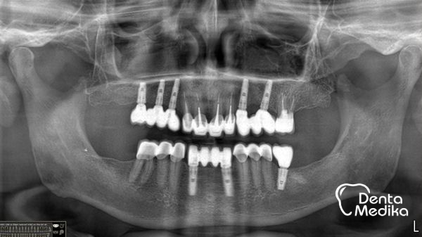 Implantáty zubů Brno - Dentamedika_cz - 17_7