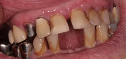 DentaMedika zubní Brno - Zásuvné spoje 2