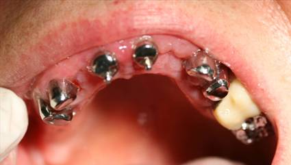 DentaMedika zubní Brno - Zásuvné spoje 3