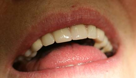 DentaMedika zubní Brno - Zásuvné spoje 1