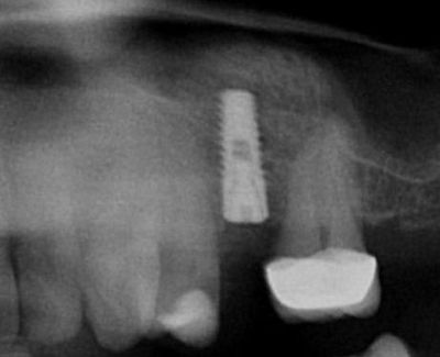 Sinus lift Brno - implantáty X5