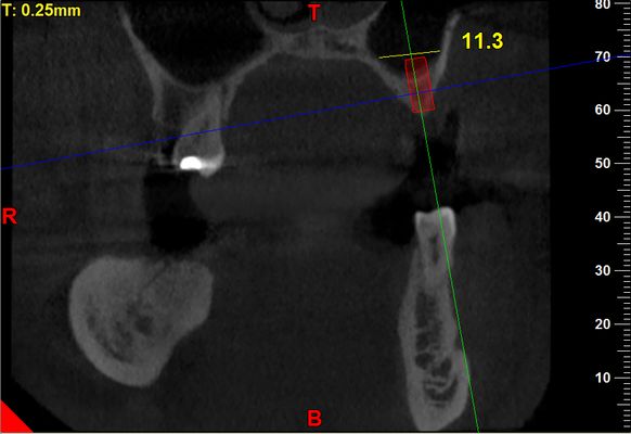 Sinus lift Brno - Zubní implantáty 1_1