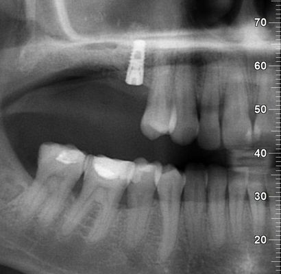 Sinus lift Brno - Zubní implantáty 2_3
