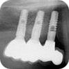 Sinus lift Brno - Zubní implantáty x3