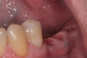 Zubní implantáty Brno - příklad 5_2