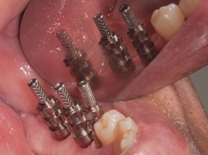 Zubní implantáty Brno - příklad 5_3