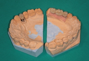 Zubní implantáty Brno - příklad 5_4