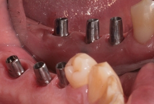 Zubní implantáty Brno - příklad 5_5
