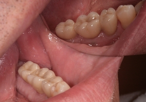 Zubní implantáty Brno - příklad 5_6