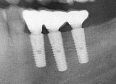 Zubní implantáty Brno 5_7