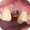 Zubní implantáty Brno - Nahrazení premoláru