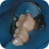 Zubní implantáty Brno - Příklad 13_ico