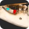Doplnění chybějící kosti před implantací s použitím nevstřebatelné PTFE membrány